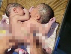 Lahir dengan tiga kaki, tim RSUP HAM belum pastikan Lakukan Operasi Bayi Kembar Siam