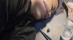 AS Remaja 17 Tahun Alami Luka Serius Diduga Jadi Korban Penganiayaan